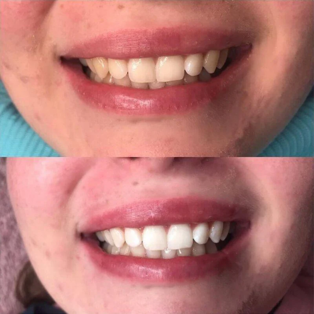 SmileKit LED – Zahnaufhellung mit LED für ein weißeres Lächeln