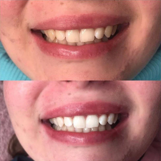 SmileKit LED – Zahnaufhellung mit LED für ein weißeres Lächeln