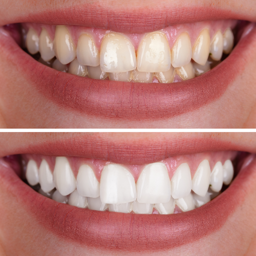SmileKit LED – Zahnaufhellung mit LED für ein weißeres Lächeln